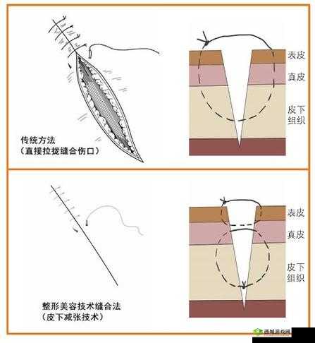 竹板打肿臂缝合不上:为何如此严重