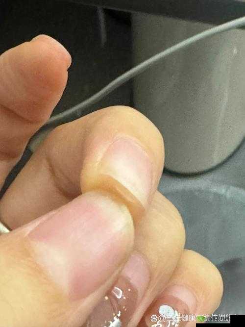 小缝红肿疼痛,不能合拢,是怎么回事?